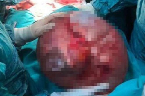 Qarın ağrısı ilə həkimə getdi - Düz 46 kiloluq şiş.../FOTOLAR