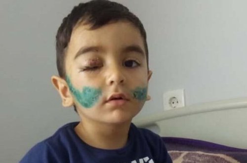 Üzünü it parçalayan Hüseynin son vəziyyəti - FOTO