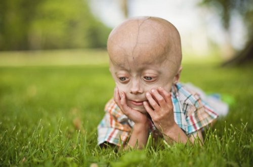 8 milyonda bir uşağın dəhşətli sonu... – PROGERİYA NƏDİR?