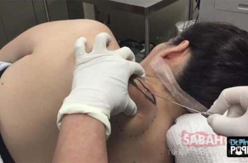 Şok edən görüntü! Qadının kürəyindən görün nə çıxdı... - fotolar