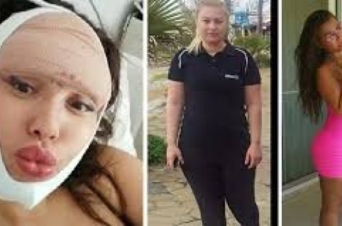 Saxta həkimə dodaq dolğusu etdirdi, qaşları yandı - FOTOLAR