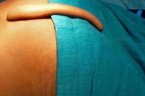 Azərbaycanda 17 yaşlı oğlanda quyruq aşkarlanıb - FOTO