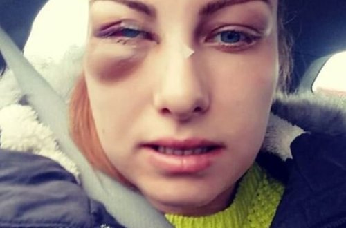 Gənc qız sevgilisi tərəfindən vəhşicəsinə döyüldü: KOR QALA BİLƏR - FOTOLAR