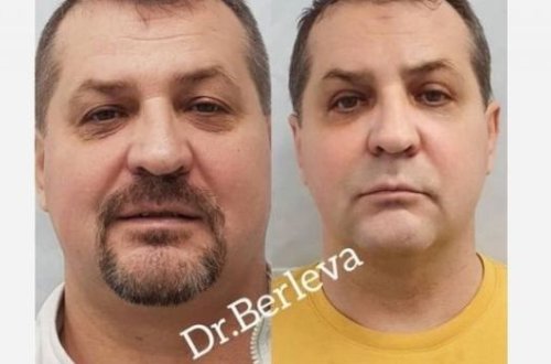 Пластическая операция не помогла россиянину скрыться от полиции - ВИДЕО