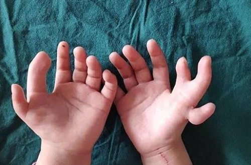 14 barmaqdan hansını kəsmək qərarı həkimləri düşündürdü