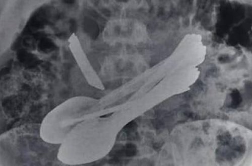 Belə şey nə görüldü, nə də eşidildi - Mədəsindən elə şeylər çıxdı ki,...