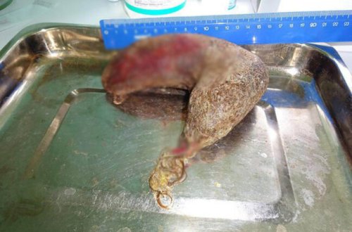 16 yaşlı qızın mədəsindən çıxanlara inanmayacaqsınız - Şok Foto