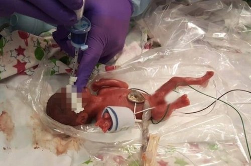 Dünyanın ən kiçik körpəsi - 245 qram doğuldu + Fotolar