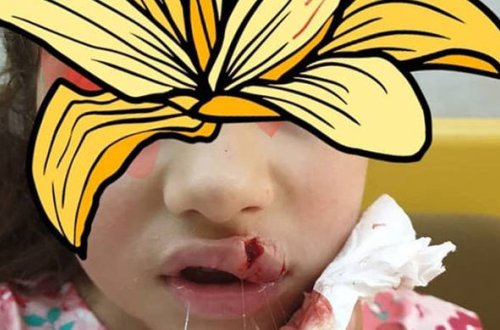 Novxanıda 6 yaşlı uşağı restoranda it dişləyib