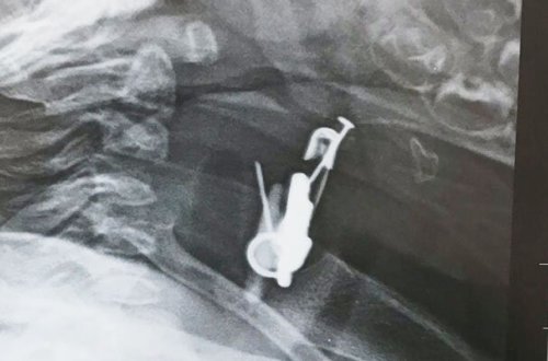 Gözdəyməmək üçün vurmuşdular, körpə uddu - Azərbaycanda+Foto