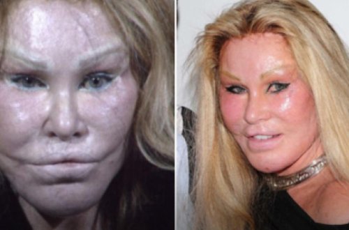 Самая известная жертва пластической хирургии вышла замуж в 71 год - 7 ФОТО