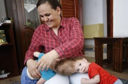 Türkiyənin siyam əkizləri: 