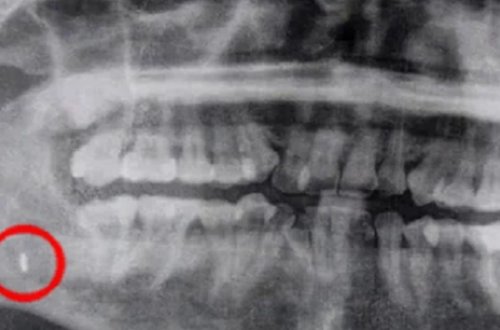 Həkimlər qızın ağzından 5 il əvvəl unudulmuş əşyanı çıxartdılar