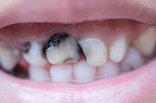 Bu qidalar dişləri MƏHV EDİR - Məşhur stomatoloqdan VACİB XƏBƏRDARLIQ