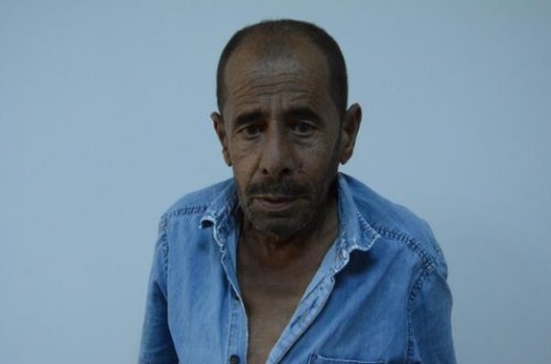 Bu kişi nadir xəstəliklərdən birinə tutuldu: qolları öz-özündən şişir