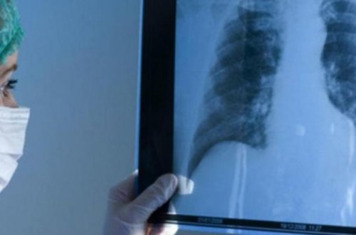 Стало известно, сколько людей в Азербайджане заразились туберкулезом в I полугодии