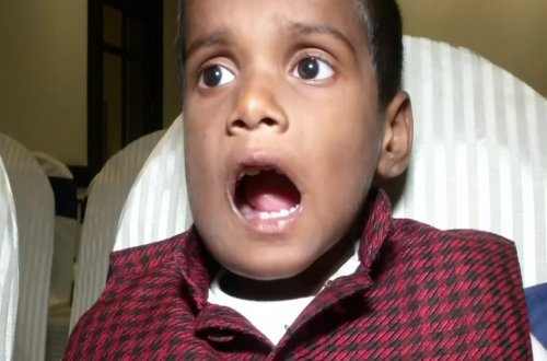 Hindistanda azyaşlının ağzından 526 diş çıxarılıb - VİDEO