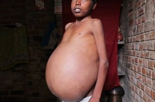 Uşağın qarnı müəmmalı şəkildə şişir, həkimlər çarə bilmir – Tibdə kuryoz