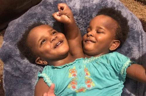 Eyni bədəndə iki ayrı həyat - Fotolar