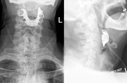 Əməliyyat zamanı protez dişləri boğazına düşdü