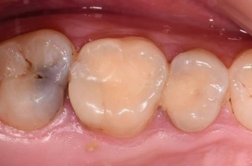 Diş ağrısını BİR DƏQİQƏDƏ kəsən MÖHTƏŞƏM ÜSUL - Video