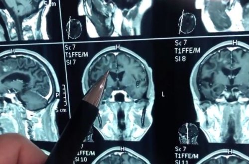 Мужчина 30 лет жил с червем в мозге