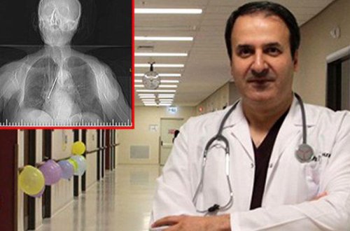 91 yaşlı kişinin ağciyərindən çıxan görənləri DƏHŞƏTƏ GƏTİRİR - VİDEO - FOTO