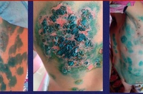 Минздрав о неизвестной болезни в Балакене