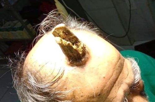 У мужчины вырос 10-сантиметровый 