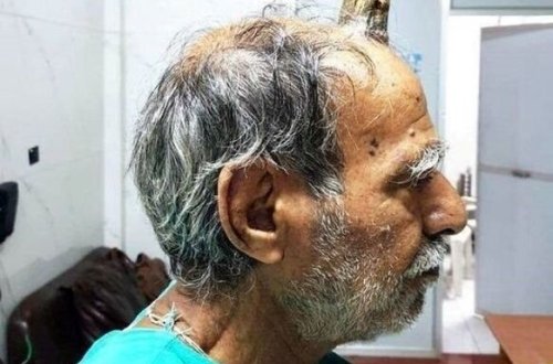 Kişi 10 santimetrlik buynuz çıxardı - FOTO