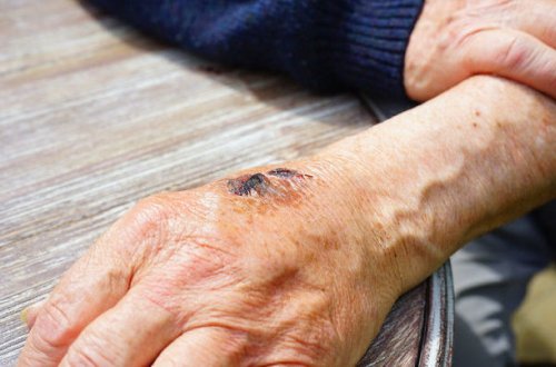 Министерство о состоянии больных сибирской язвой