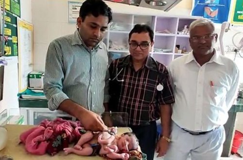 Dörd ayaqlı, üç əlli körpə doğuldu