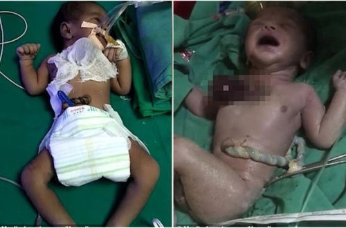 Ürəyi bədənin xaricində olan uşaq doğulub - VİDEO