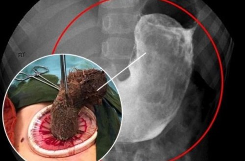 Врачи извлекли из желудка девочки 2 килограмма волос