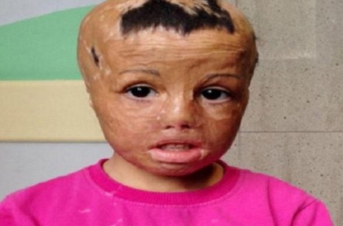 Üzü yanan qıza öz toxumasından yeni üz köçürələcək - FOTO