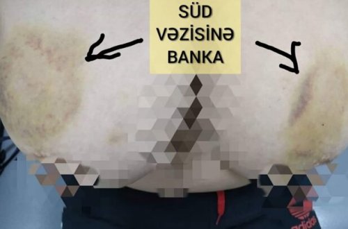 Azərbaycanda qadın süd vəzilərinə banka qoydu – Dəhşətli nəticə + FOTOLAR