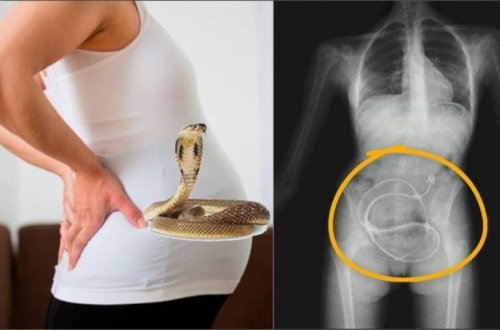 Həkimlər şokda: Hamilə qadının bətnindən uşaq əvəzinə ilan çıxdı - VİDEO