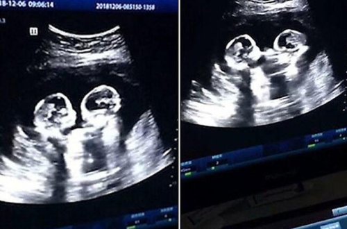 Əkizlərin ana bətnində savaşı - Maraqlı VİDEO