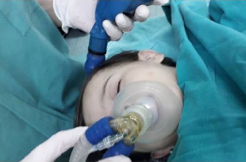 Bakıda qələmin başlığı azyaşlının boğazında qaldı - SON ANDA....