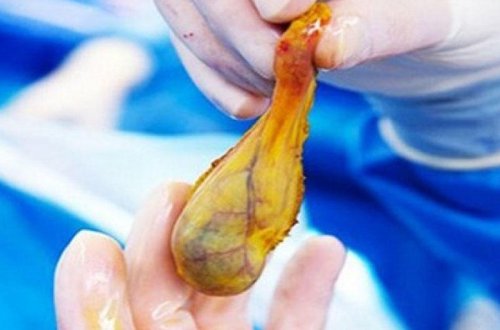 Öd kisəsi çıxarıldıqdan sonrakı həyat - Əməl olunmalı 3 qayda