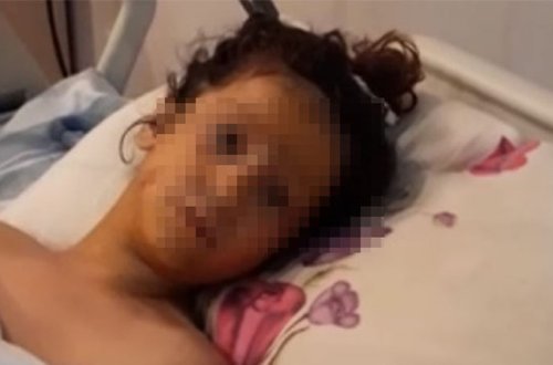 Transformatora girən azyaşlının 2 ayağı və qolu amputasiya edildi