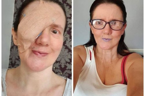 Уборщица осталась без глаза, вытерев лицо полотенцем на отдыхе