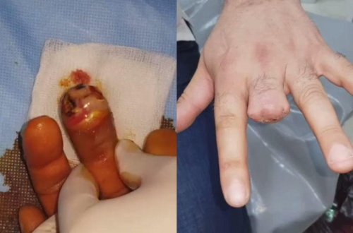 Zibil qutusundakı küçə iti barmağını dişlədi, barmağı kəsildi - VİDEO