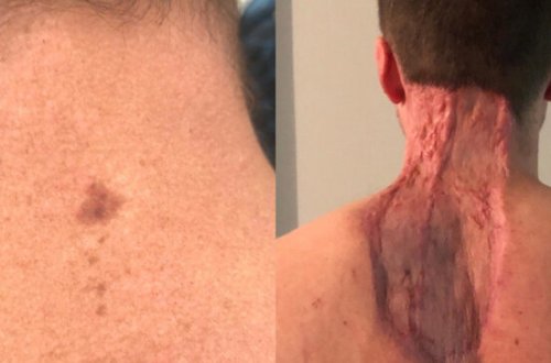 Balaca xal qorxunc xəstəliyin əlaməti imiş - FOTO