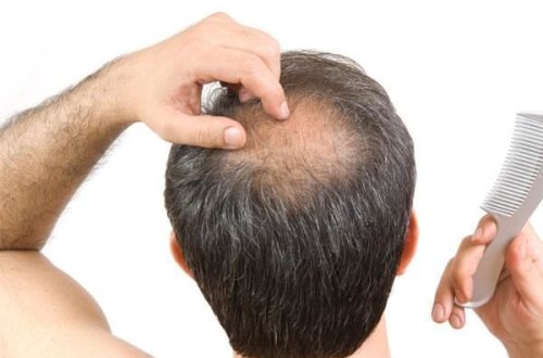 Keçəlləşmənin yeni səbəbi aşkar edildi