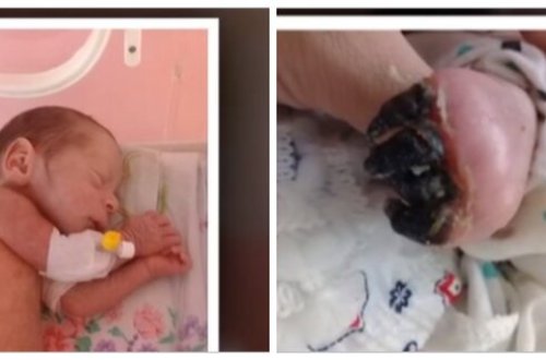 Azərbaycanda 3 aylıq körpənin barmaqları həkim səhvinə qurban getdi - FOTOLAR