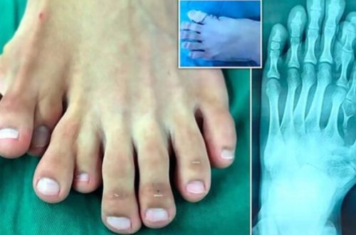 Юноша десятки лет ходил с девятью пальцами на ноге из-за суеверных родителей