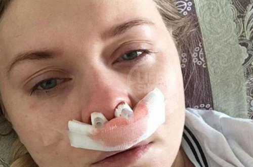 Həkim xəstənin burnunda kateteri unutdu - 10 il sonra bütün üz sümükləri irinlədi