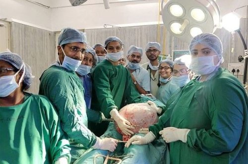 Hamilə olduğunu zənn edən qadının qarnından 18 kiloqramlıq şiş çıxdı - FOTO