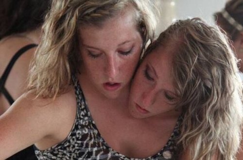 Tək bədəndə yaşayan siam əkizləri – Daxili orqanları cütdür